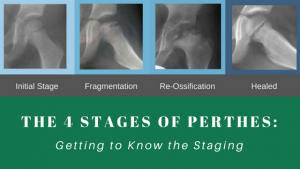 Getting to Know the Four Stages of Perthes