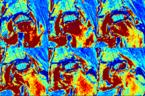 Hipvasc – A quantitative method to assess blood flow to the femoral head